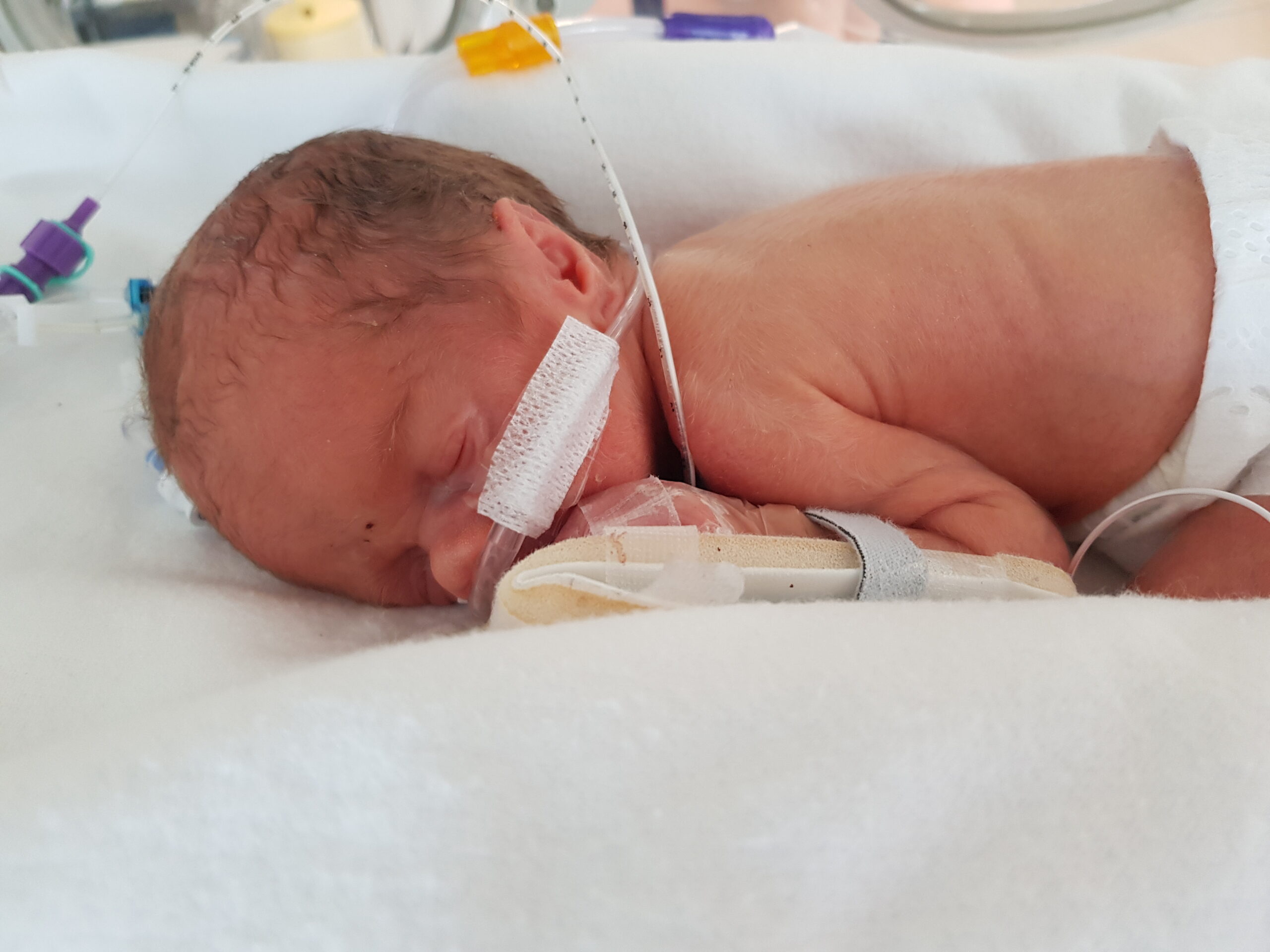 Alfie in neonatal unit Picture: The Stars Appeal